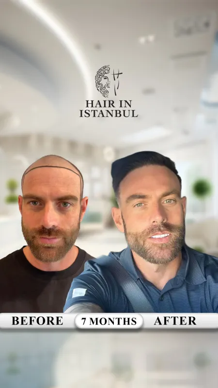 Hair transplant before and after · Hair in Istanbul, Istanbul