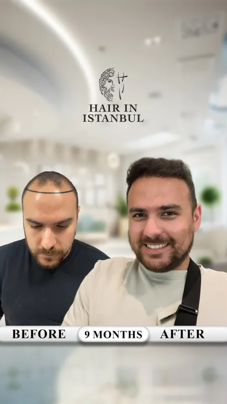 Hair transplant before and after · Hair in Istanbul, Istanbul