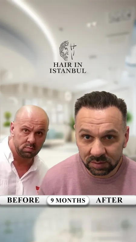 Hair transplant before and after · Hair in Istanbul, Istanbul