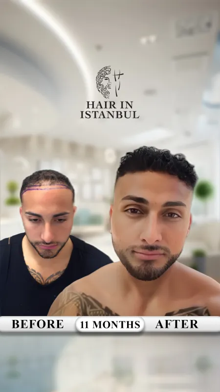Hair transplant before and after · Hair in Istanbul, Istanbul