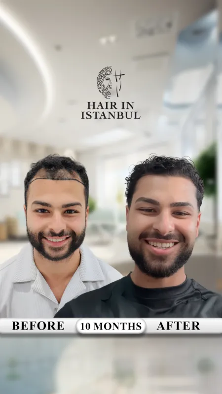 Hair transplant before and after · Hair in Istanbul, Istanbul