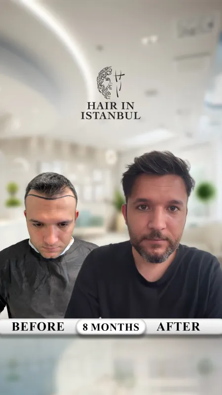 Hair transplant before and after · Hair in Istanbul, Istanbul
