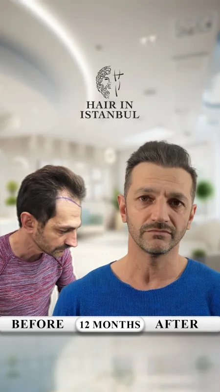 Hair transplant before and after · Hair in Istanbul, Istanbul