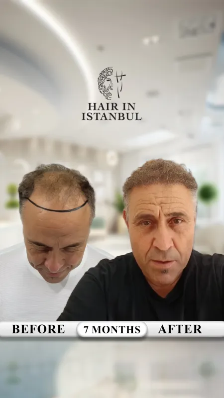 Hair transplant before and after · Hair in Istanbul, Istanbul