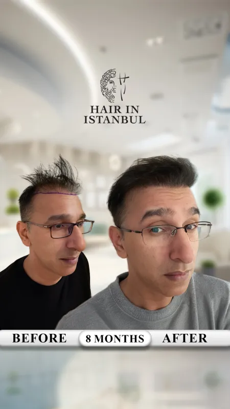 Hair transplant before and after · Hair in Istanbul, Istanbul