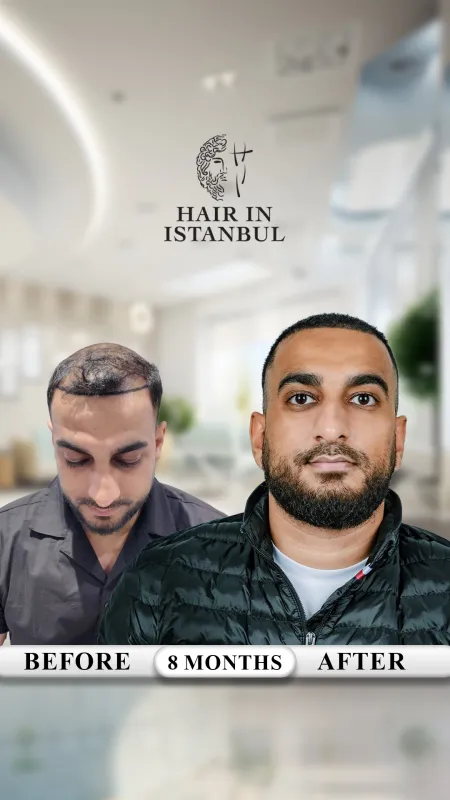 Hair transplant before and after · Hair in Istanbul, Istanbul