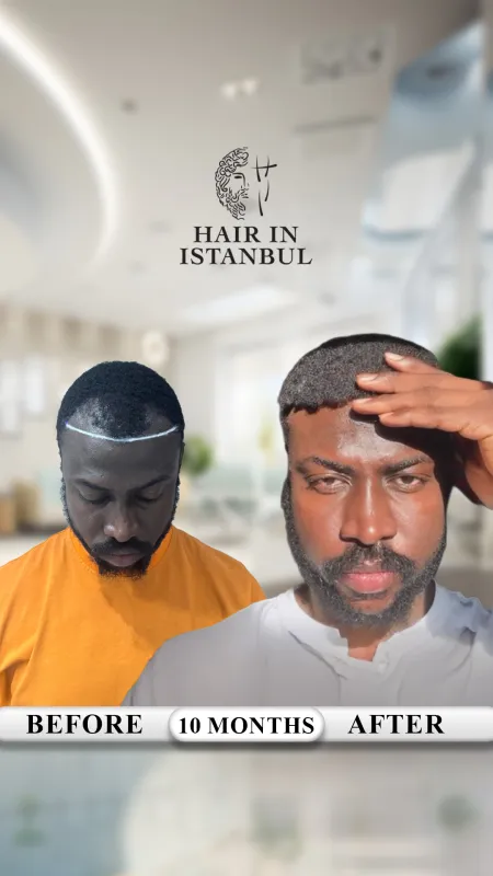 Hair transplant before and after · Hair in Istanbul, Istanbul