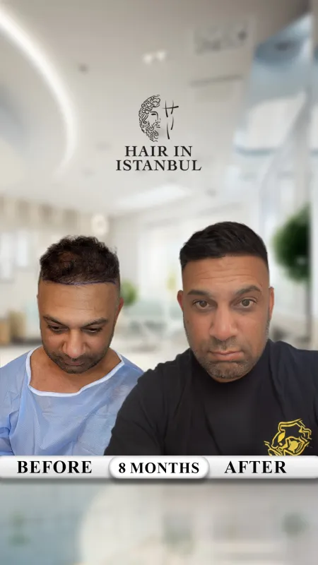 Hair transplant before and after · Hair in Istanbul, Istanbul