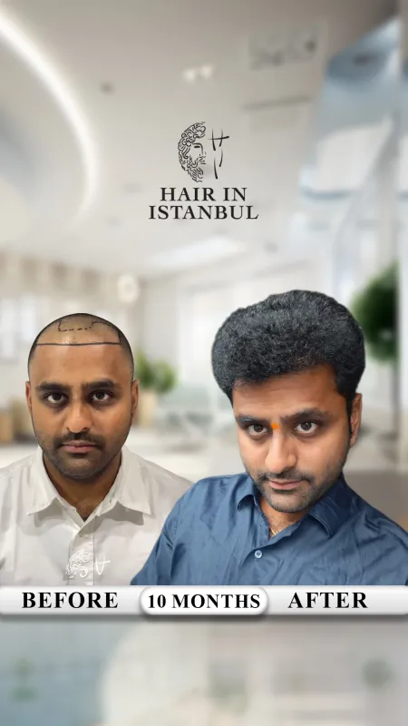 Hair transplant before and after · Hair in Istanbul, Istanbul