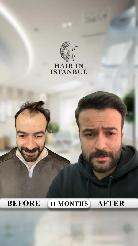 Hair transplant before and after · Hair in Istanbul, Istanbul