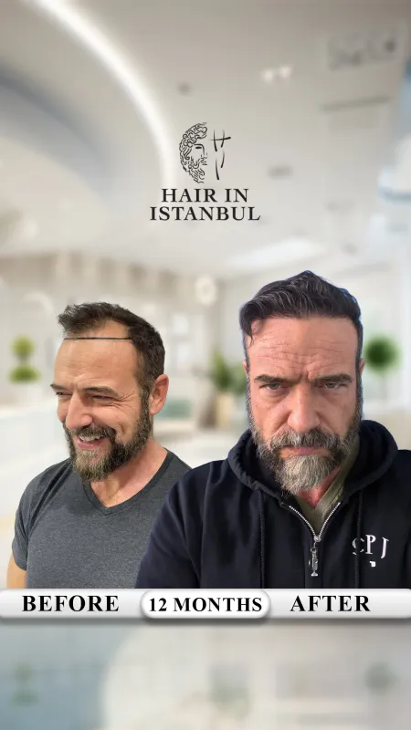 Hair transplant before and after · Hair in Istanbul, Istanbul