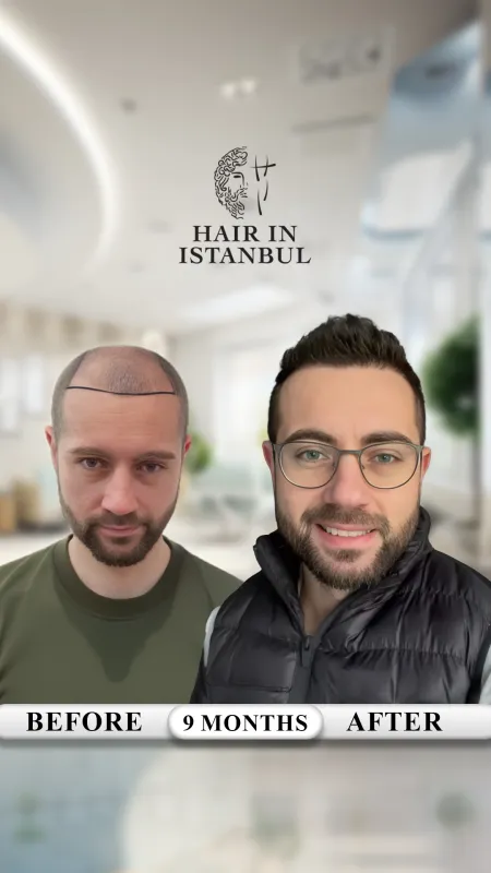 Hair transplant before and after · Hair in Istanbul, Istanbul