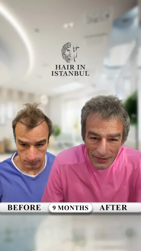 Hair transplant before and after · Hair in Istanbul, Istanbul