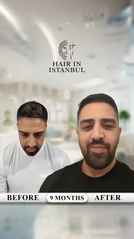 Hair transplant before and after · Hair in Istanbul, Istanbul