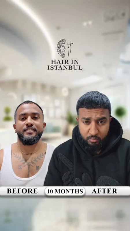 Hair transplant before and after · Hair in Istanbul, Istanbul