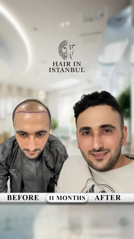 Hair transplant before and after · Hair in Istanbul, Istanbul