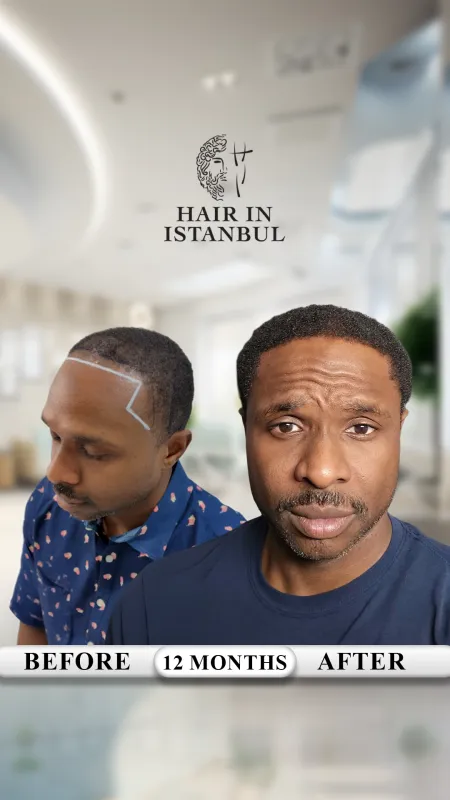 Hair transplant before and after · Hair in Istanbul, Istanbul