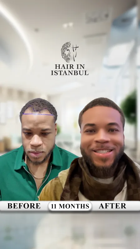 Hair transplant before and after · Hair in Istanbul, Istanbul