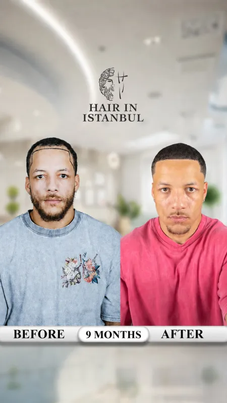 Hair transplant before and after · Hair in Istanbul, Istanbul