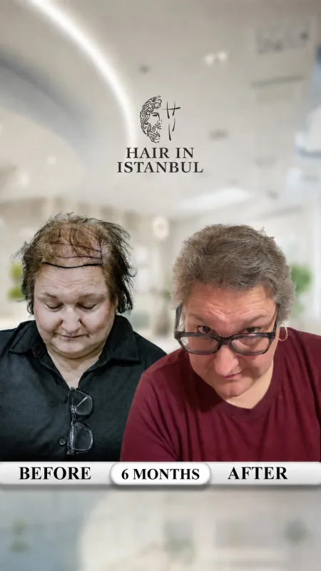 Hair transplant before and after · Hair in Istanbul, Istanbul