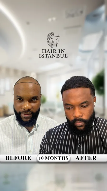 Hair transplant before and after · Hair in Istanbul, Istanbul