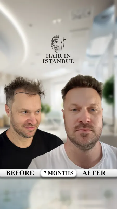 Hair transplant before and after · Hair in Istanbul, Istanbul